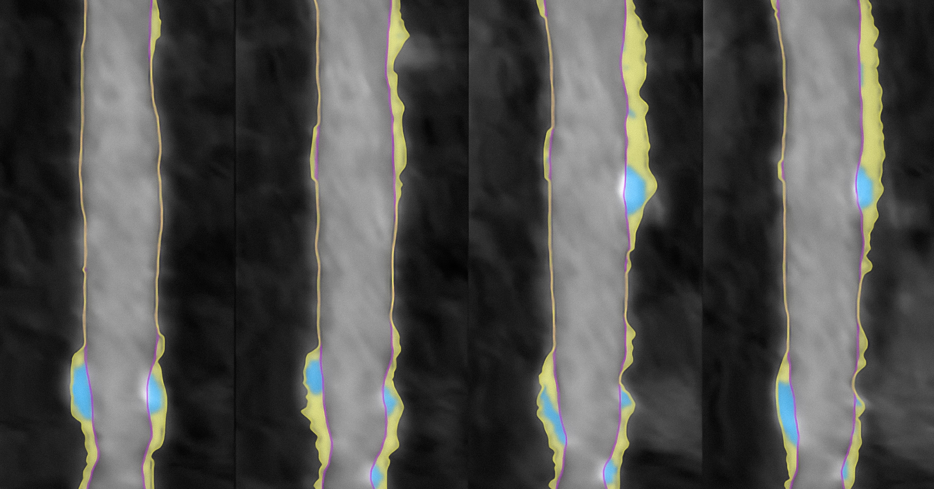severe heart plaque burden