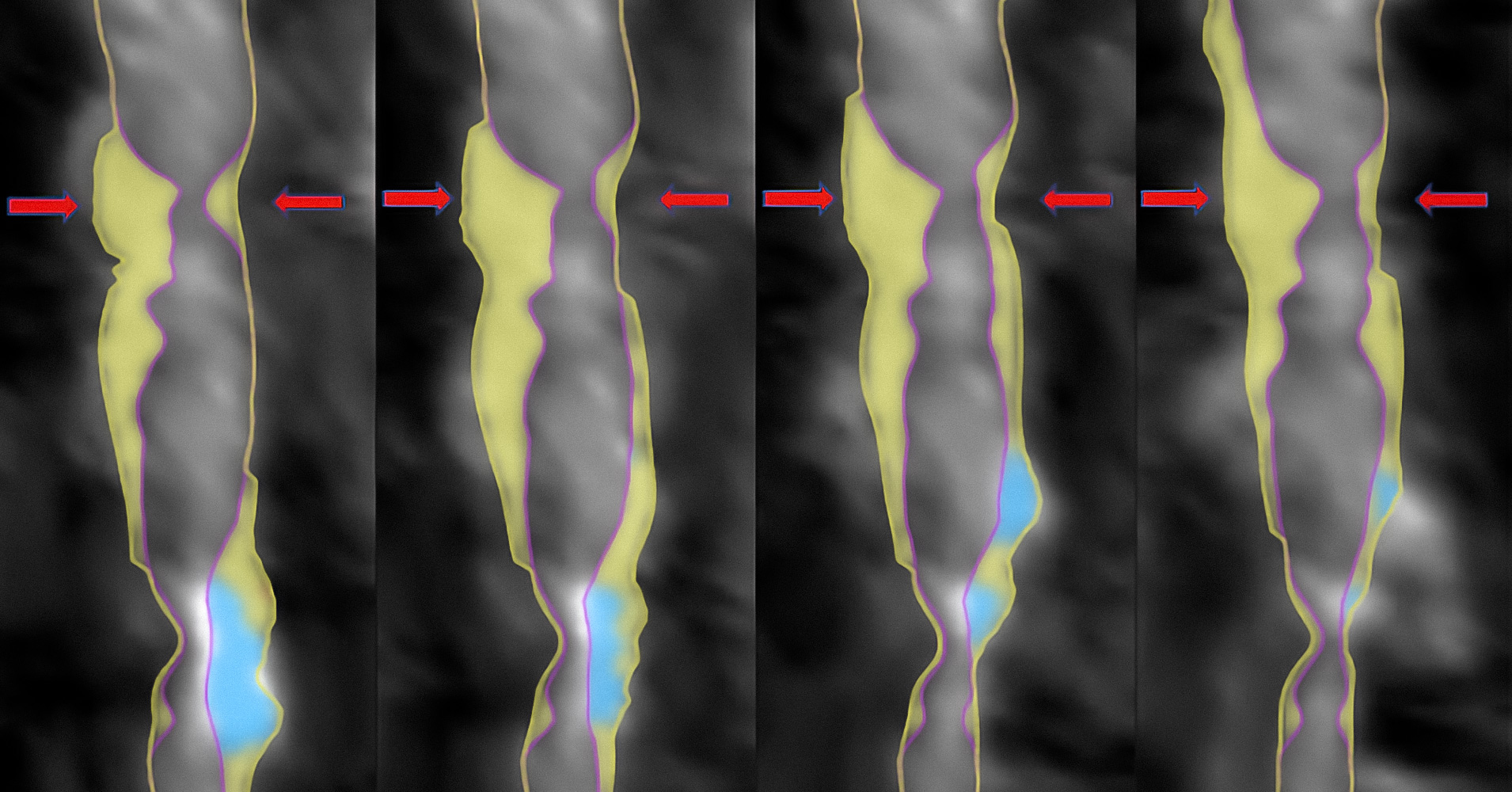 74% stenosis of pCx