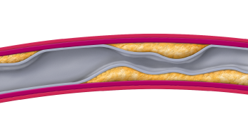 cleerly-reveals-ischemia-illustration