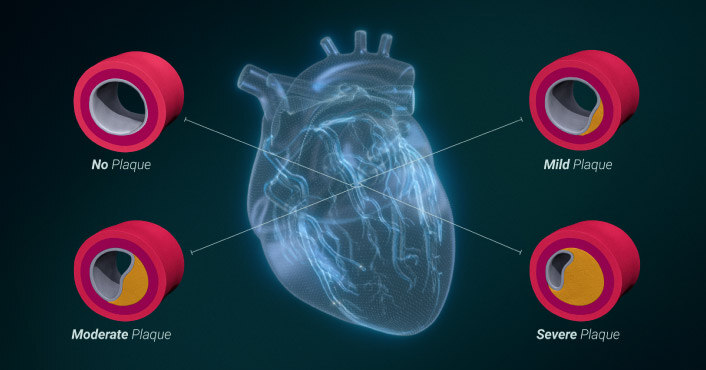 New Staging System for Coronary Artery Disease